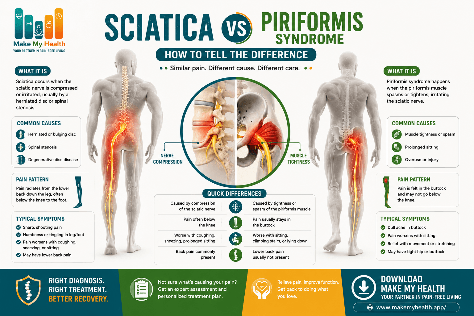 Sciatica vs Piriformis Syndrome: How to Tell the Difference